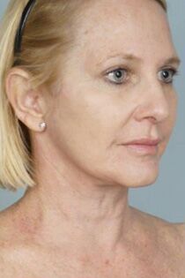 Laser Skin Resurfacing Before & After Patient #2218