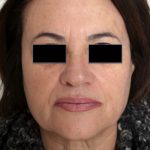 Laser Skin Resurfacing Before & After Patient #2197