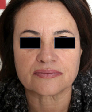 Laser Skin Resurfacing Before & After Patient #2197