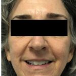 Laser Skin Resurfacing Before & After Patient #2214