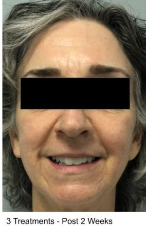 Laser Skin Resurfacing Before & After Patient #2214