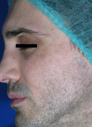 Laser Skin Resurfacing Before & After Patient #2201