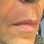 Laser Skin Resurfacing Before & After Patient #2199