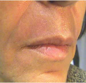 Laser Skin Resurfacing Before & After Patient #2199