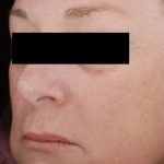 Laser Skin Resurfacing Before & After Patient #2216