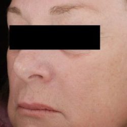 Laser Skin Resurfacing Before & After Patient #2216