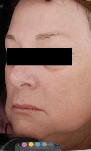 Laser Skin Resurfacing Before & After Patient #2216