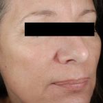 Laser Skin Resurfacing Before & After Patient #2215