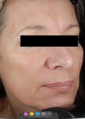 Laser Skin Resurfacing Before & After Patient #2215