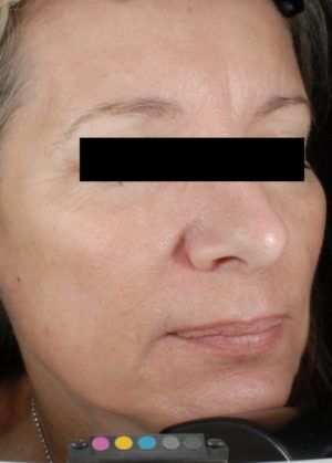 Laser Skin Resurfacing Before & After Patient #2215