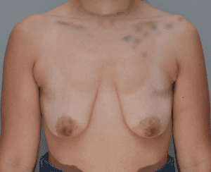 Breast Augmentation Before & After Patient #357