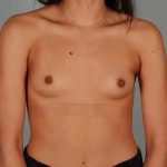 Breast Augmentation Before & After Patient #2880