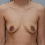 Breast Augmentation Before & After Patient #2869