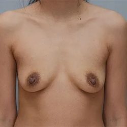 Breast Augmentation Before & After Patient #2869
