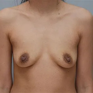 Breast Augmentation Before & After Patient #2869