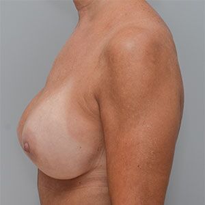 Breast Implant Exchange Before & After Patient #861