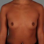 Breast Augmentation Before & After Patient #67