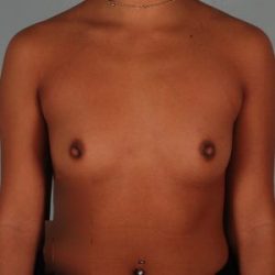 Breast Augmentation Before & After Patient #67