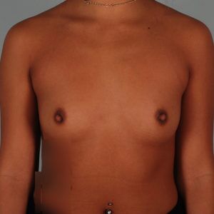 Breast Augmentation Before & After Patient #67