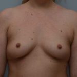 Breast Augmentation Before & After Patient #472