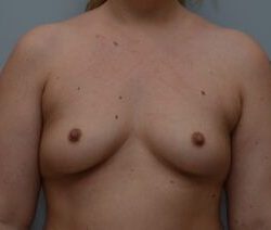 Breast Augmentation Before & After Patient #472