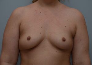 Breast Augmentation Before & After Patient #472