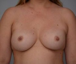 Breast Augmentation Before & After Patient #472