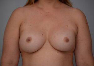 Breast Augmentation Before & After Patient #472
