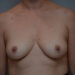 Breast Augmentation Before & After Patient #471