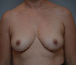 Breast Augmentation Before & After Patient #471