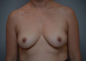 Breast Augmentation Before & After Patient #471