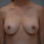 Breast Augmentation Before & After Patient #471