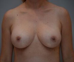 Breast Augmentation Before & After Patient #471