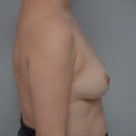 Breast Augmentation Before & After Patient #471