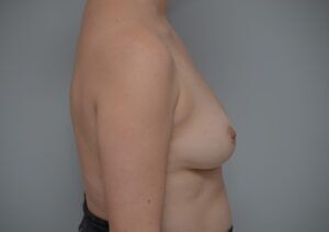 Breast Augmentation Before & After Patient #471