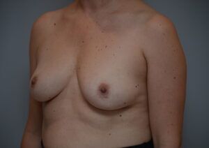 Breast Augmentation Before & After Patient #471