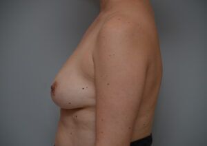 Breast Augmentation Before & After Patient #471