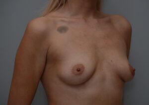 Breast Augmentation Before & After Patient #470