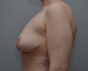 Breast Lift Before & After Patient #1026