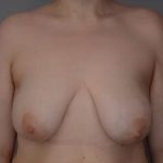 Breast Lift Before & After Patient #1026