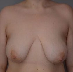Breast Lift Before & After Patient #1026