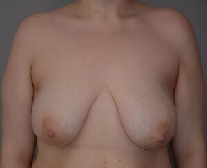 Breast Lift Before & After Patient #1026