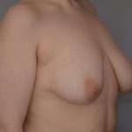 Breast Lift Before & After Patient #1026