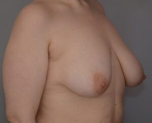 Breast Lift Before & After Patient #1026