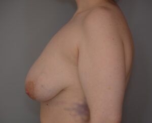 Breast Lift Before & After Patient #1026