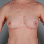 Breast Augmentation Before & After Patient #356