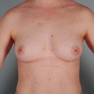 Breast Augmentation Before & After Patient #356