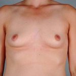 Breast Augmentation Before & After Patient #305