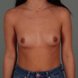 Breast Augmentation Before & After Patient #304