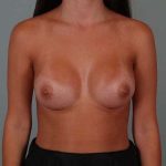 Breast Augmentation Before & After Patient #304